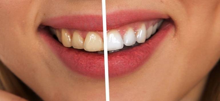 Blanquear tus dientes con carbón activado tiene sus riesgos