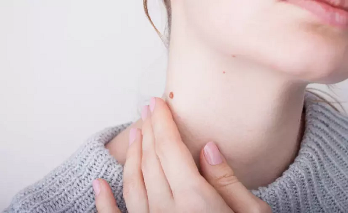 ¿Tienes verrugas en el cuello? Podría estar enfermo de VPH