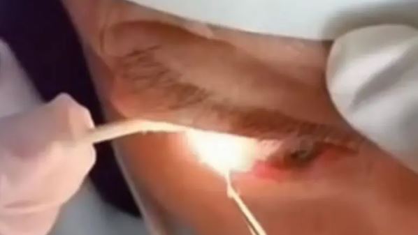 VIDEO: Extraen 20 gusanos del ojo de un sexagenario en China
