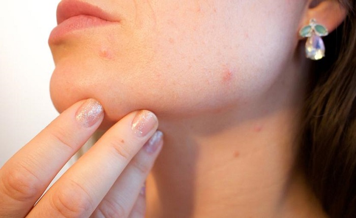 Coronavirus: ¿estrés y dermatitis podrían agravarse durante encierro?