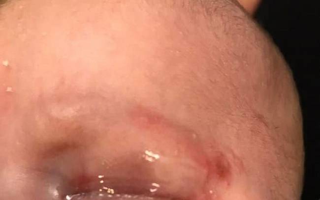 Bebé contrae herpes en el ojo por recibir un beso durante su bautizo