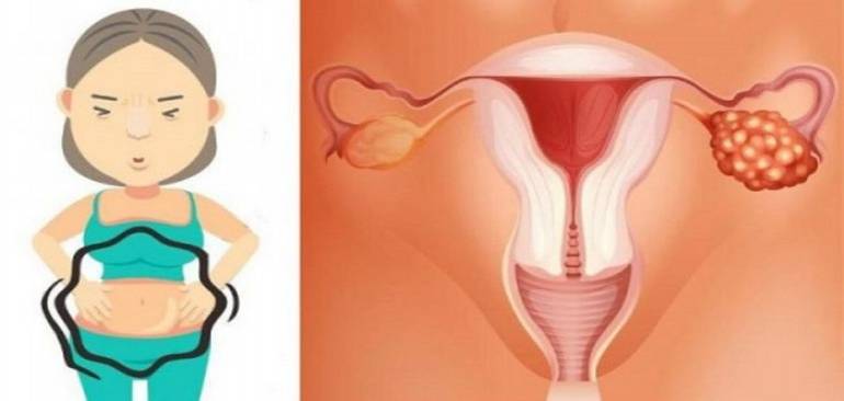 Los 4 primeros síntomas que la mujer presenta cuando desarrolla cáncer de ovario
