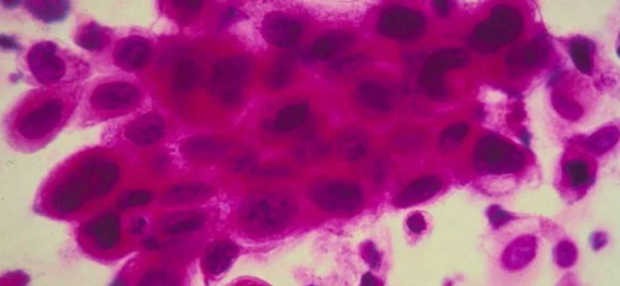 Descubren proteína que elimina metástasis de cáncer de mama