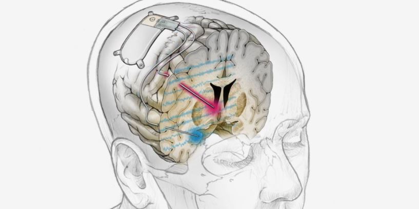 Implantan con éxito dispositivo cerebral a paciente para tratar la depresión