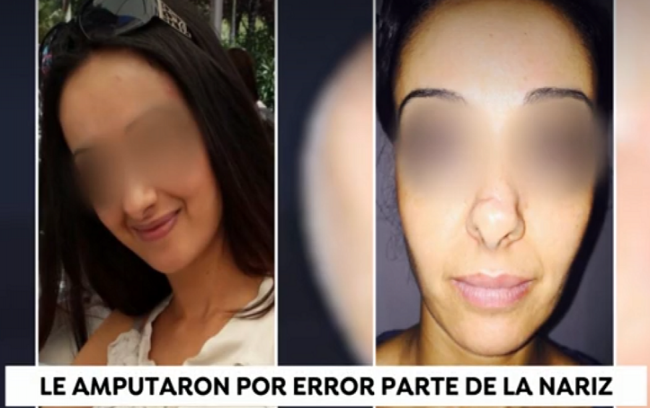 Mujer se somete a rinoplastia y le amputan parte de la nariz