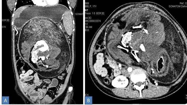 Una joven vivió 17 años con un 'gemelo' dentro de su cuerpo sin saberlo