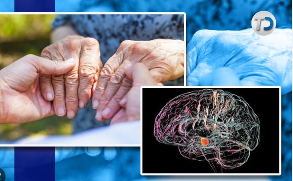 Cuántos años puede vivir una persona con Parkinson