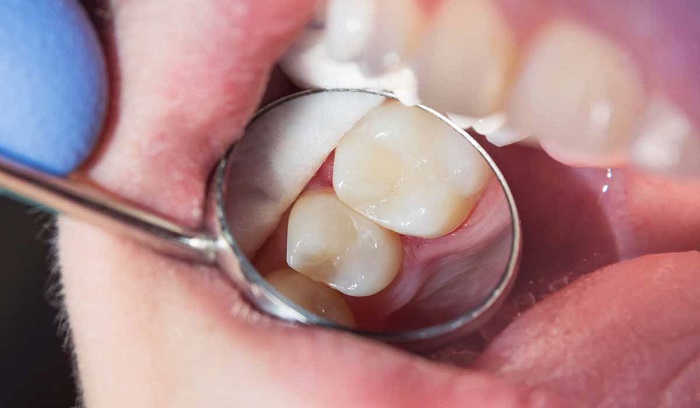 Aunque no lo creas, las caries podrían causar tu muerte ¿Lo sabías?