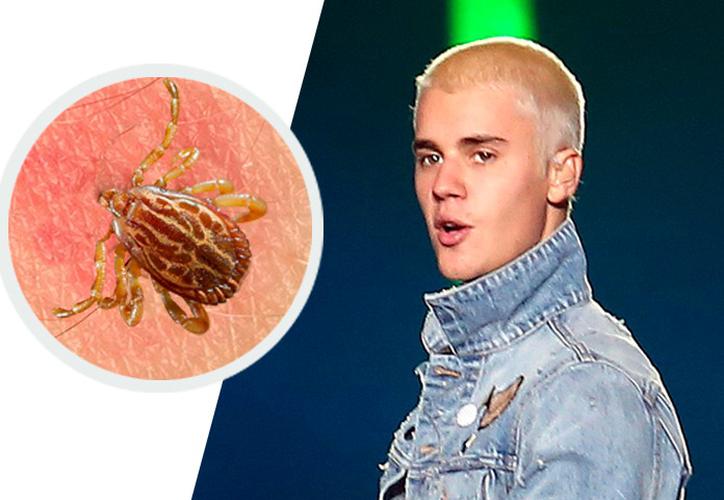 Justin Bieber confiesa que tiene una infección causada por garrapatas