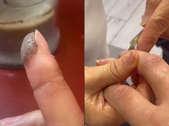 (VÍDEO) Mujer recibe injerto de piel en un dedo y le crece vello púbico