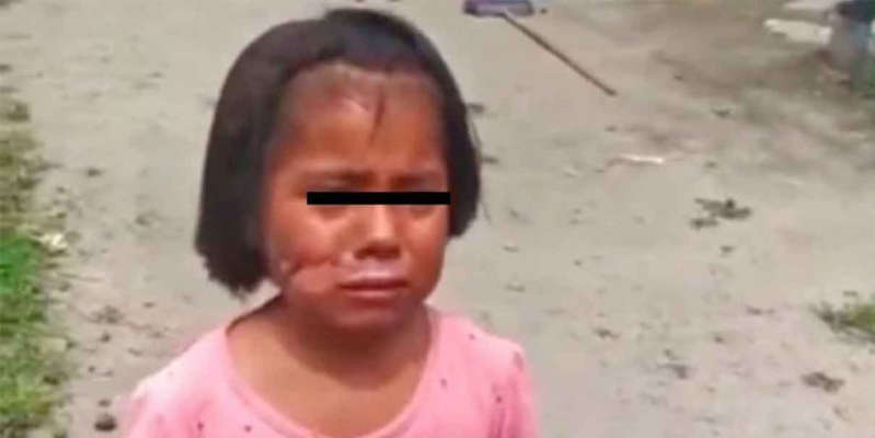 Resguarda el DIF de Puebla a menor que fue quemada por su abuela