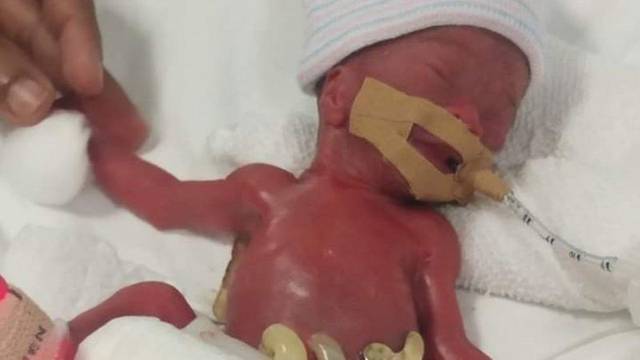La bebé más pequeña del mundo vence todo pronóstico y sale del hospital
