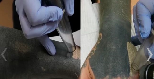 Joven quiere quitarse un tatuaje, pero con terribles resultados
