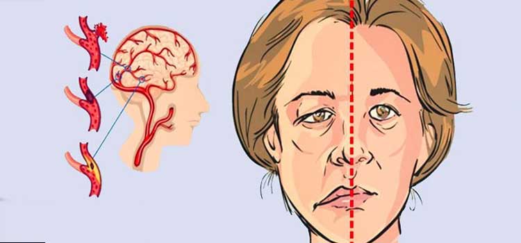 Aumentan casos de derrames cerebrales en México