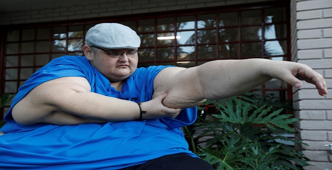 El "hombre más obeso del mundo"; así luce tras perder 300 kg