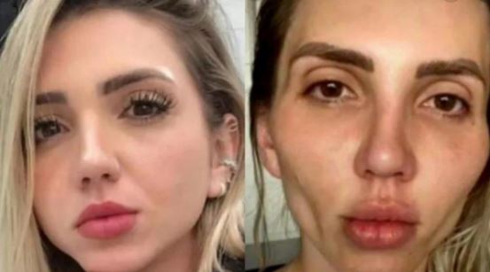 Influencer se hace la ‘Bichectomía’ y se deforma la cara