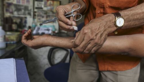 México: Cómo ha afectado la lepra durante la pandemia por COVID-19