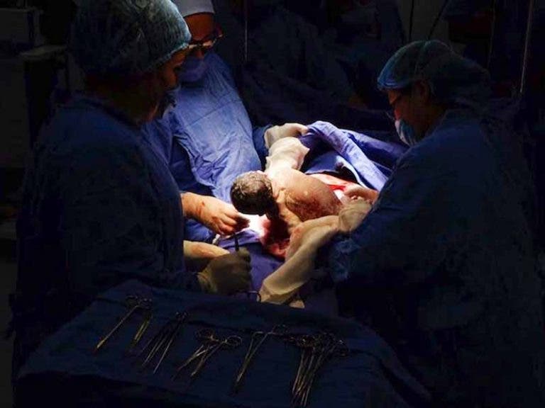 Bebé sufre cortada de 15 centímetros durante cesárea en el IMSS
