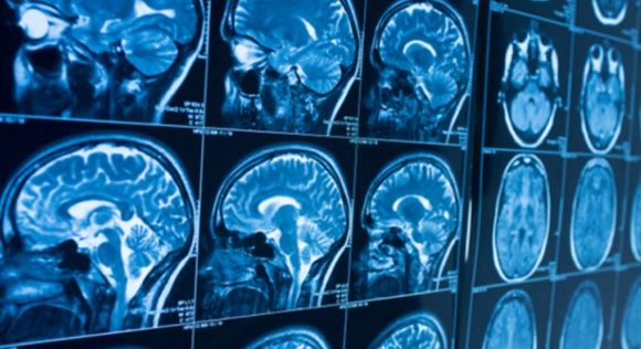 Covid no infecta el cerebro, pero puede causarle severos daños: según estudio