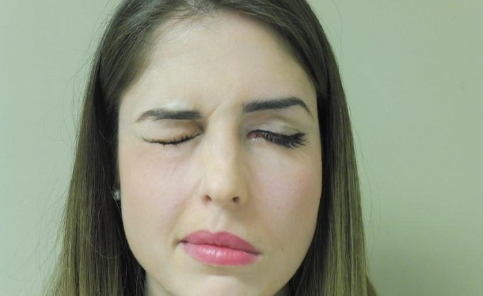 ¿Qué hacer en caso de sufrir una parálisis facial?